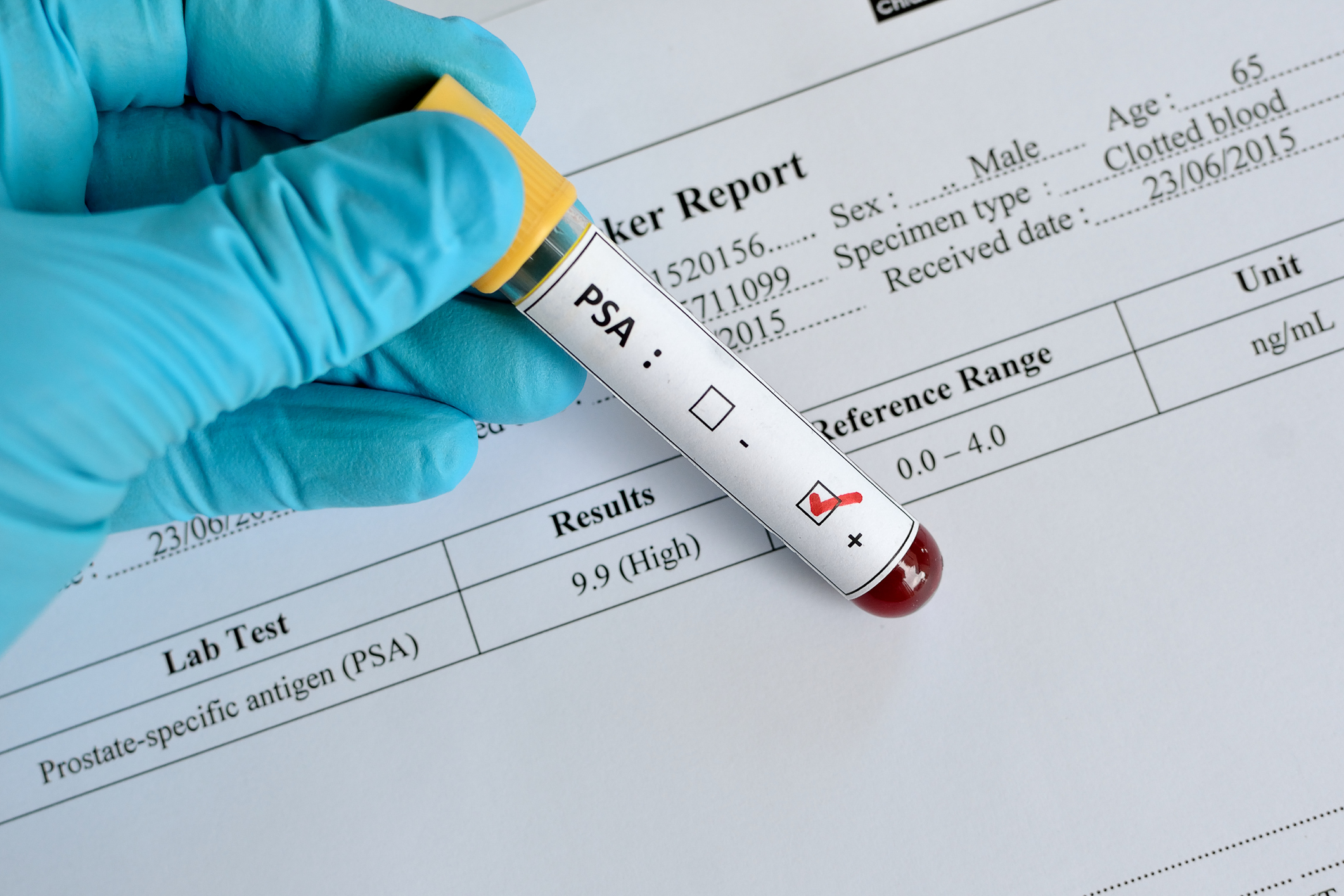 Meestearst: kodune PSA test ei tööta