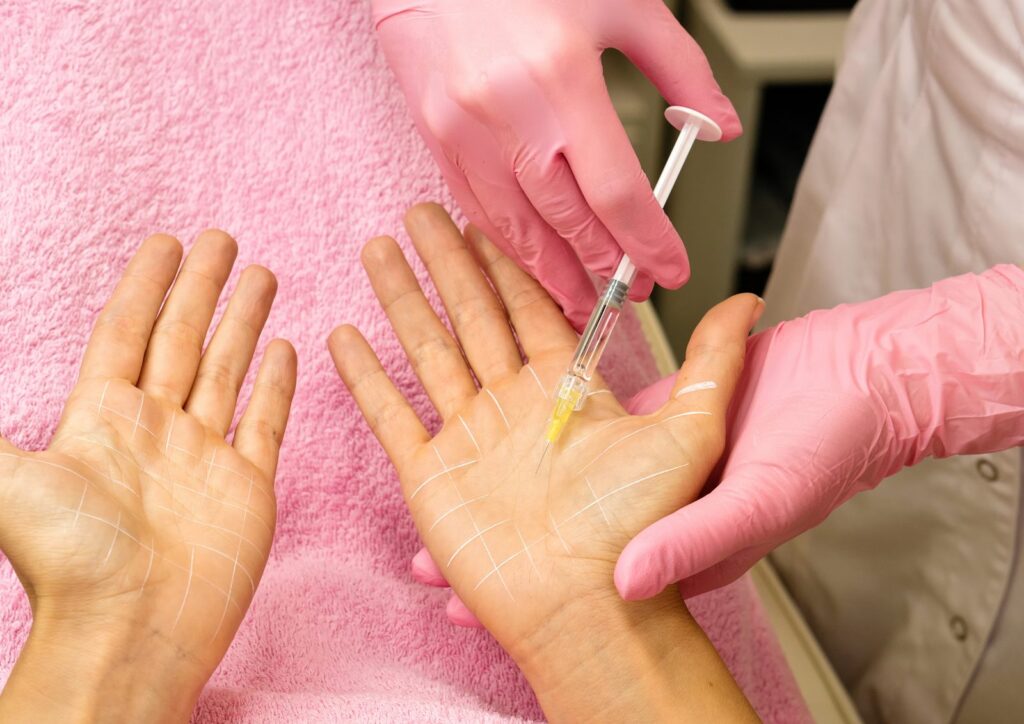 Botulinum toxin injections for palm hyperhidrosis